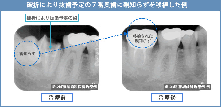 破折により抜歯予定の7番奥歯に親知らずを移植した例