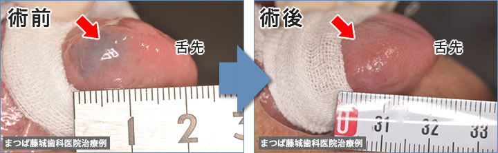 舌にできた小さな血管腫（毛細血管が増殖した良性腫瘍）の治療例