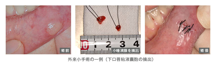 外来小手術の一例(下口唇粘液嚢胞の摘出)