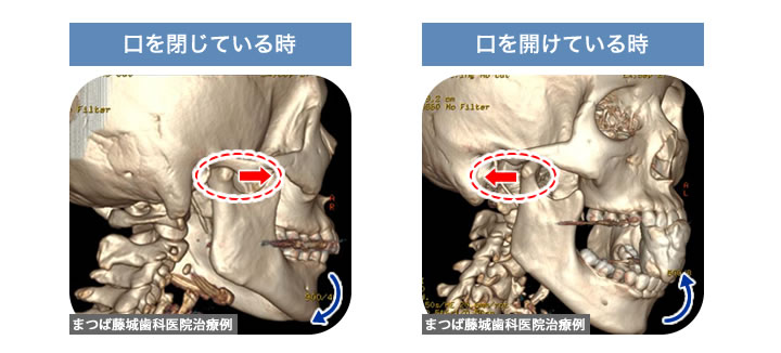 顎関節症のイメージ