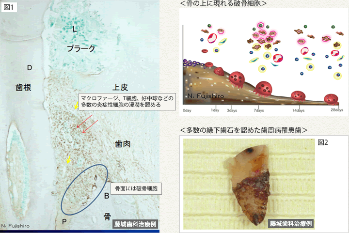 歯周炎の組織図