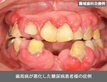 糖尿病と歯周病との関係