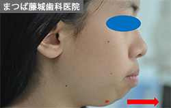 出っ歯