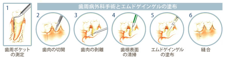 歯周病手術とエムドゲインゲルの塗布