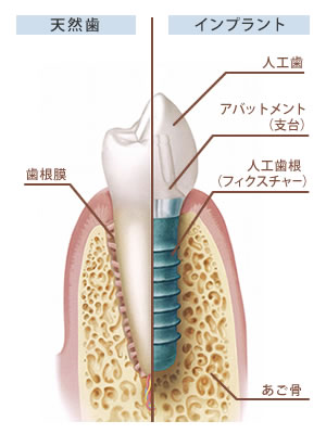 インプラント