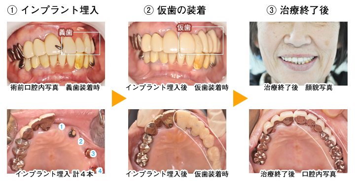 外来小手術の一例（下口唇粘液嚢胞の摘出）