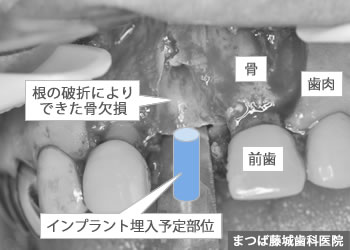 インプラント手術 2