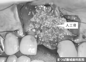インプラント手術 3