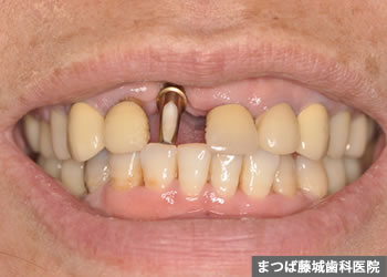 インプラント手術 4