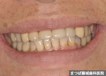 インプラント手術 5