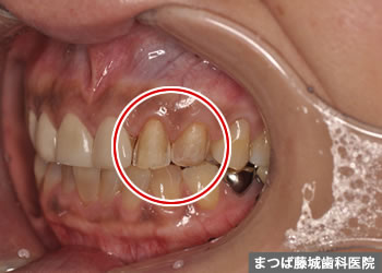 ラミネートべニアのリペア、やり替え例　1