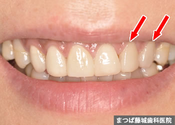 ラミネートべニアのリペア、やり替え例　3