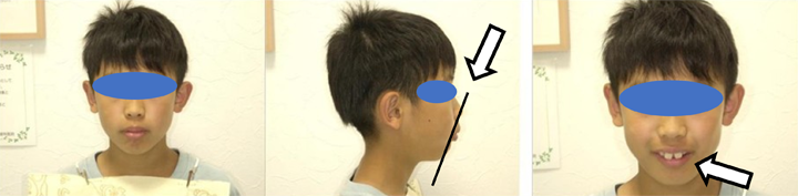 成長期を生かした矯正治療例の写真1