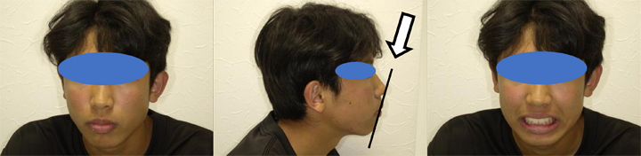 成長期を生かした矯正治療例の写真2