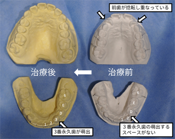 成長期を生かした矯正治療例の写真3