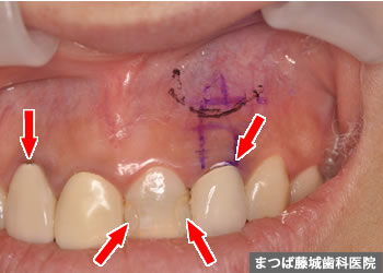 歯根嚢胞 治療写真1