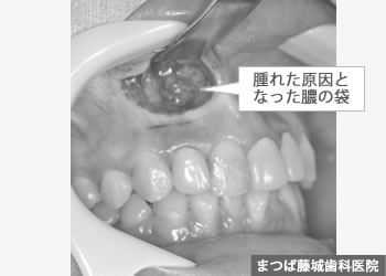 歯根嚢胞 治療写真2