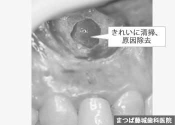 歯根嚢胞 治療写真3