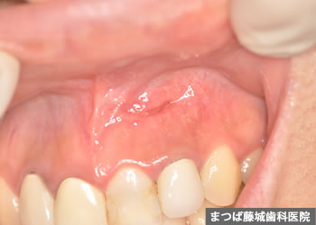 歯根嚢胞 治療写真4
