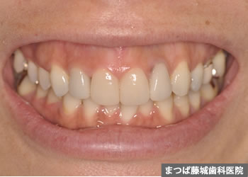 歯根嚢胞 治療写真5