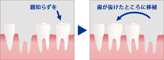 歯牙移植