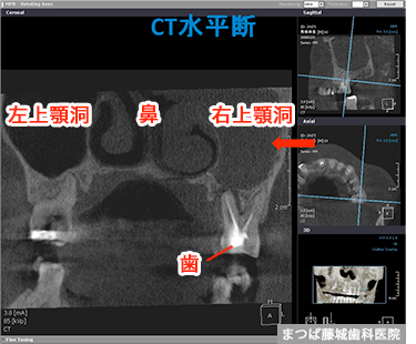 上顎洞炎（副鼻腔炎）への応用画像