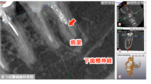 根尖病巣